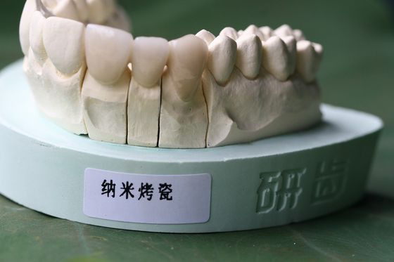 ISO13485 좋은 생물학적 적합성 PFM 비 귀중한 치아관