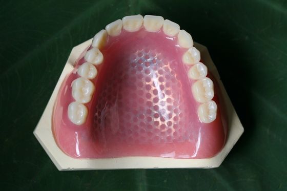 3D 프린팅 금속 골격 국소 의치 금속 뼈대