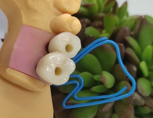 골내 치과용 임플란트 크라운