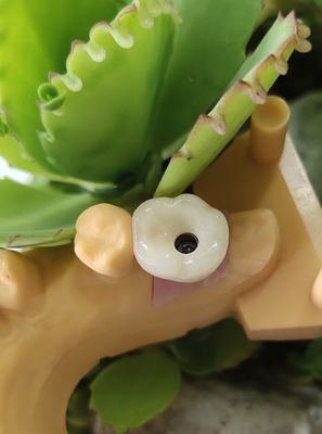 경화된 솔루션 노벨 BIOCARE 치과용 임플란트 크라운