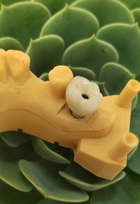 경화된 이식 크라운 다리