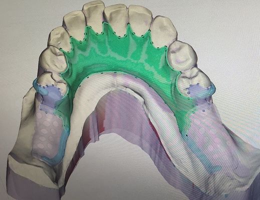 제거할 수 있는 3D 인쇄된 국소 의치 금속 뼈대