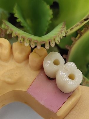 경화된 솔루션 노벨 BIOCARE 치과용 임플란트 크라운