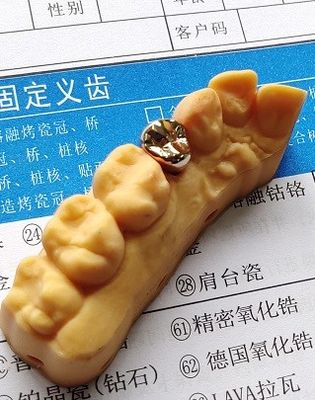 좋은 적합성 높은 귀중한 금 합극 치아관